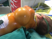 儿童心血管科顺利完成一例新生儿胸壁巨大淋巴管畸形的介入治疗