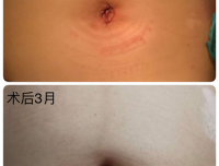 四川大学华西第二医院妇科
成功实施单孔腹腔镜手术治疗妇科恶性肿瘤
