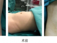 我院顺利完成首例2岁患儿经脐单孔腹腔镜手术
