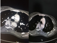 亮眼，守护妇幼健康安全！
--锦江院区放射科完成首例产妇分娩并发主动脉夹层的急诊CT检查