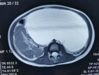 儿童心血管科一例腹腔巨大淋巴管畸形患者接受多学科协作的微创治疗
