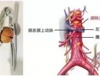 孩子出现血尿,需要警惕胡桃夹综合征!