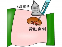 儿童肾活检知识